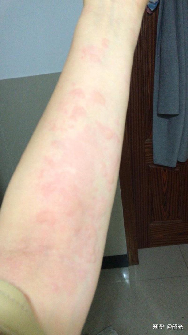 荨麻疹怎么治
