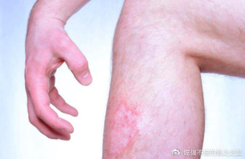 湿疹治疗选购指南：寻觅最适宜的方案