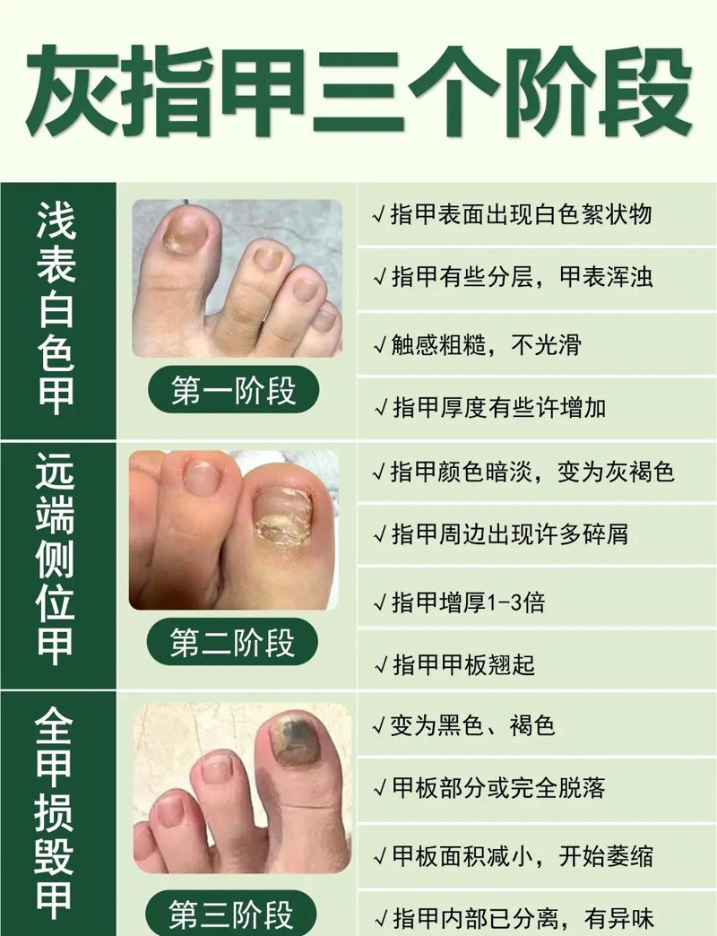 灰指甲治疗