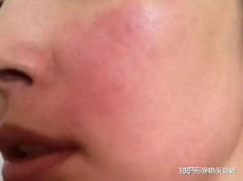 皮肤过敏怎么办